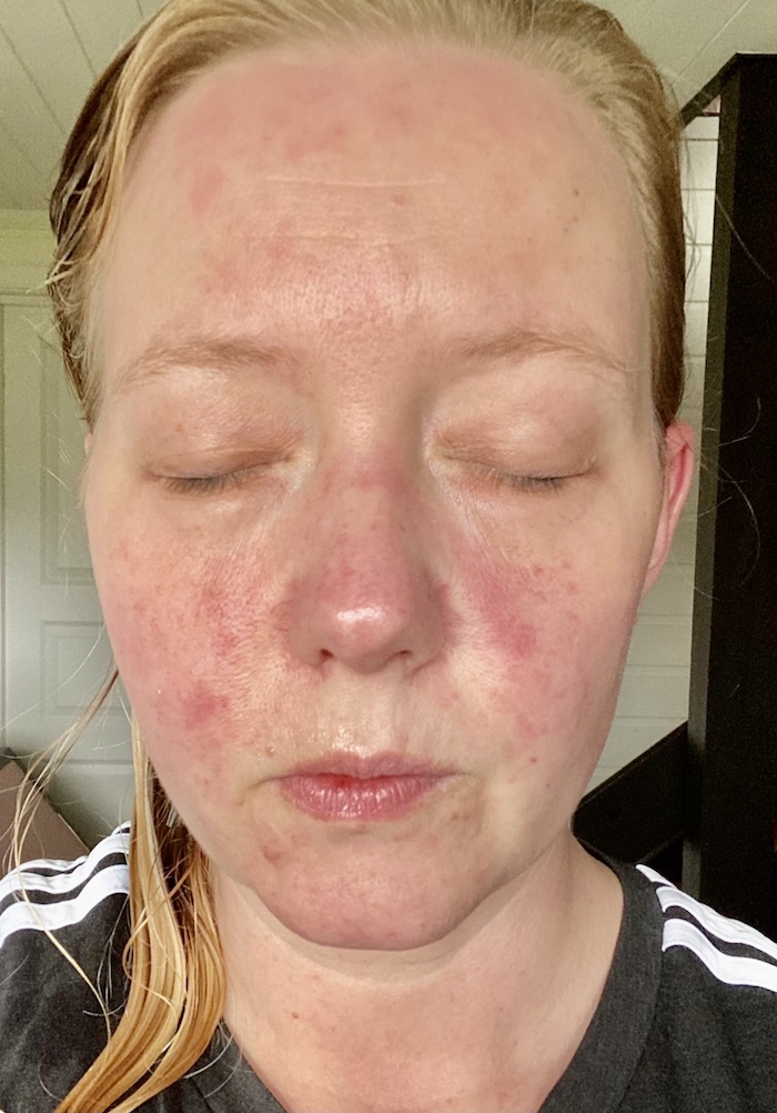 Viser Line Kyvik med allergisk reaksjon, røde flekker i ansiktet